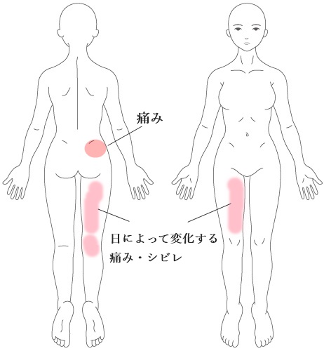 太もも 足のしびれ 神経痛 愛媛県松山市の鍼灸院 はりきゅう専門 鍼灸院めぐる